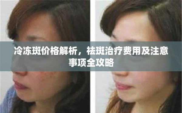 冷冻斑价格解析,祛斑治疗费用及注意事项全攻略